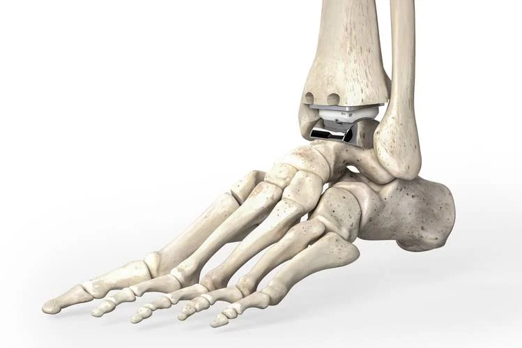 Wallstreet - Ankle Replacement.jpg