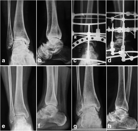 Image of Distraction Arthroplasty.gif