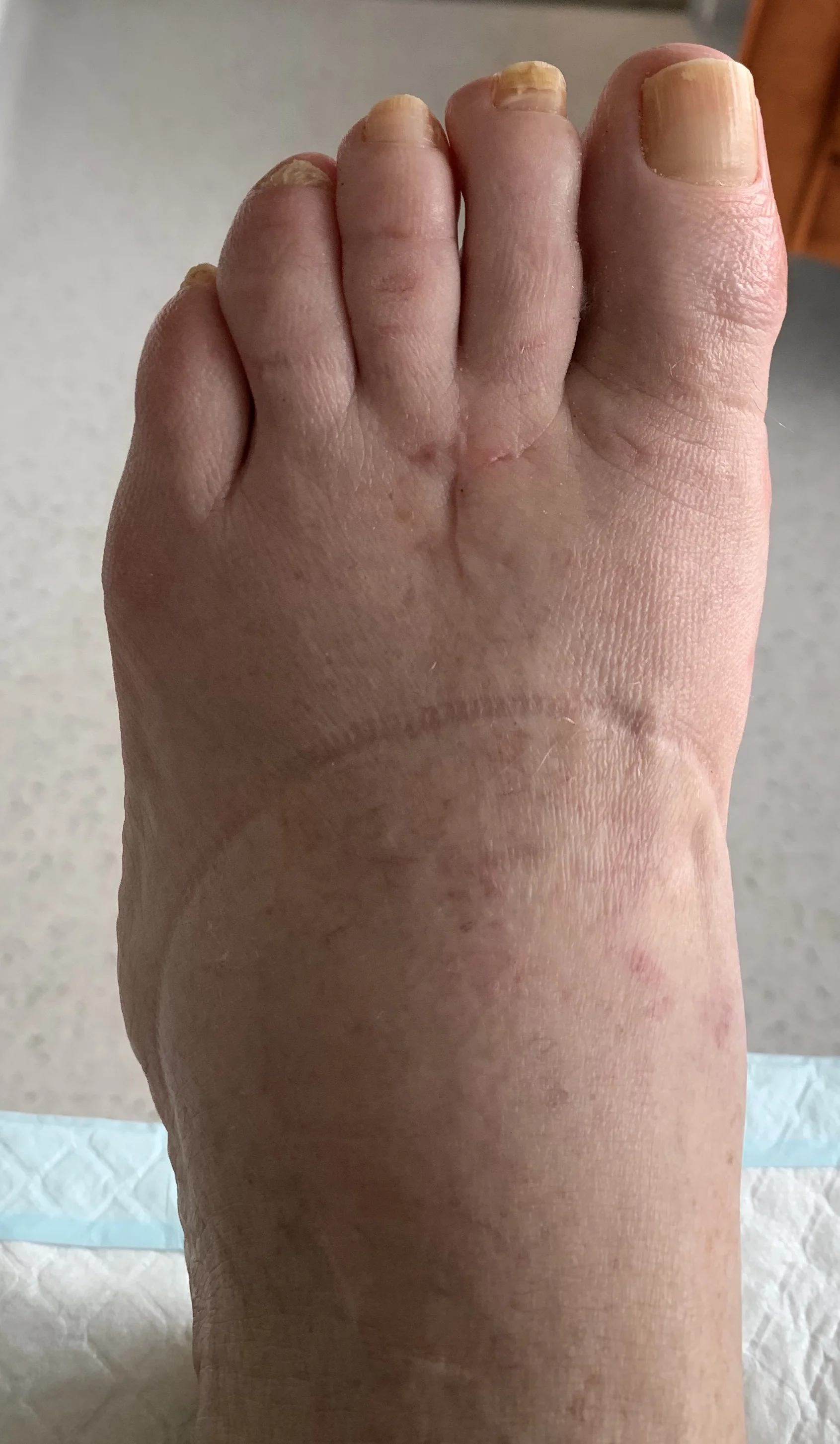 Actual Case: Post Operation For Bunion Treatment