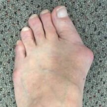 Bunion 1 Before