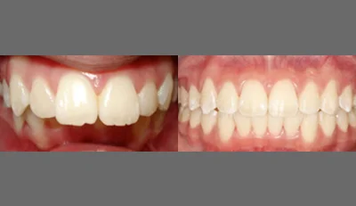 Beatrice_before_After_FrontTeeth.jpg