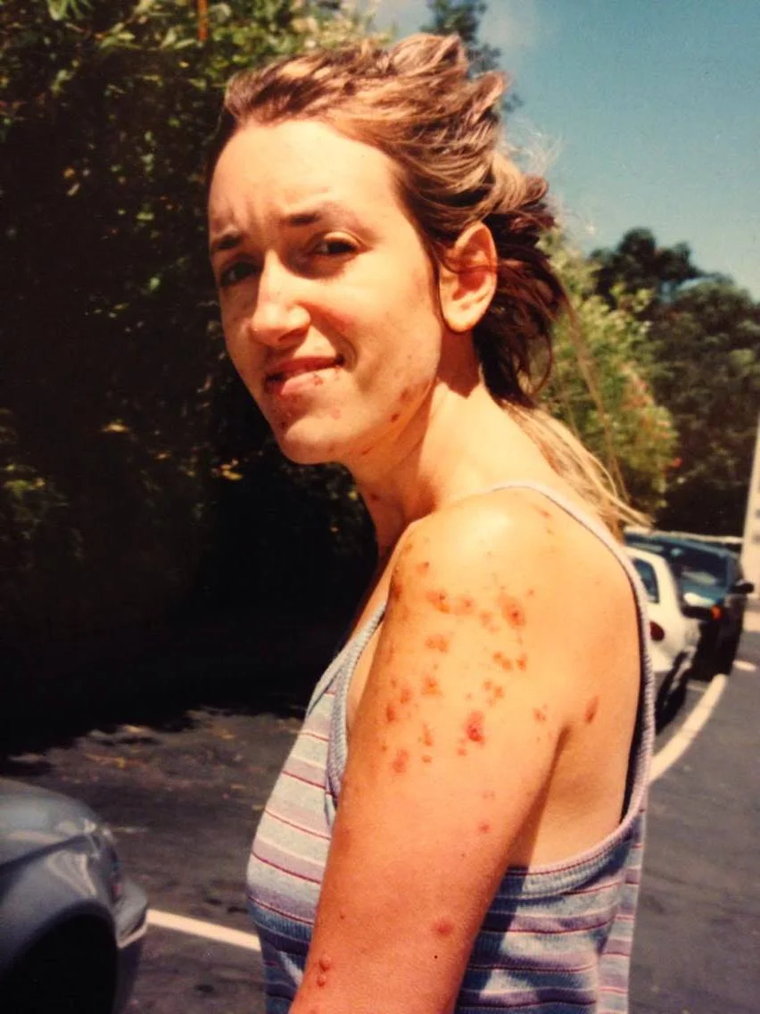July 2000 after my rash had significantly improved.