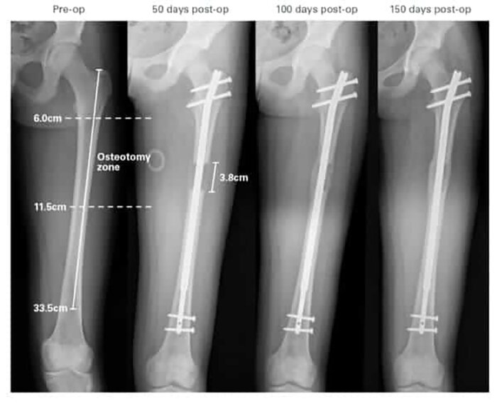 Reddit surgery leg lengthening Limb Lengthening
