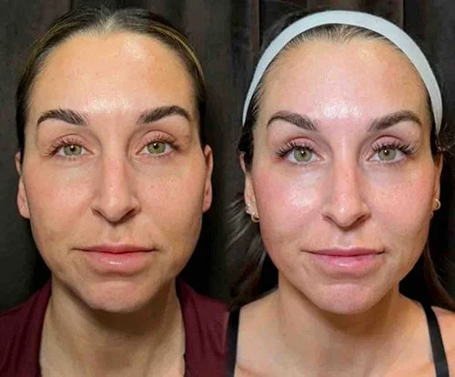 XERF Treatment: The Newest Non-Invasive, Skin-Tightening Experience