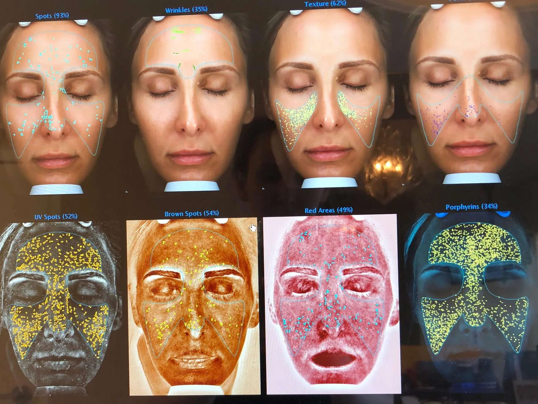 #SkinBabe Molly Boudreault shows us her skin Complexion Analysis. The system measures variables that contribute to aging including brown spots, reds, wrinkles, pore size and more.