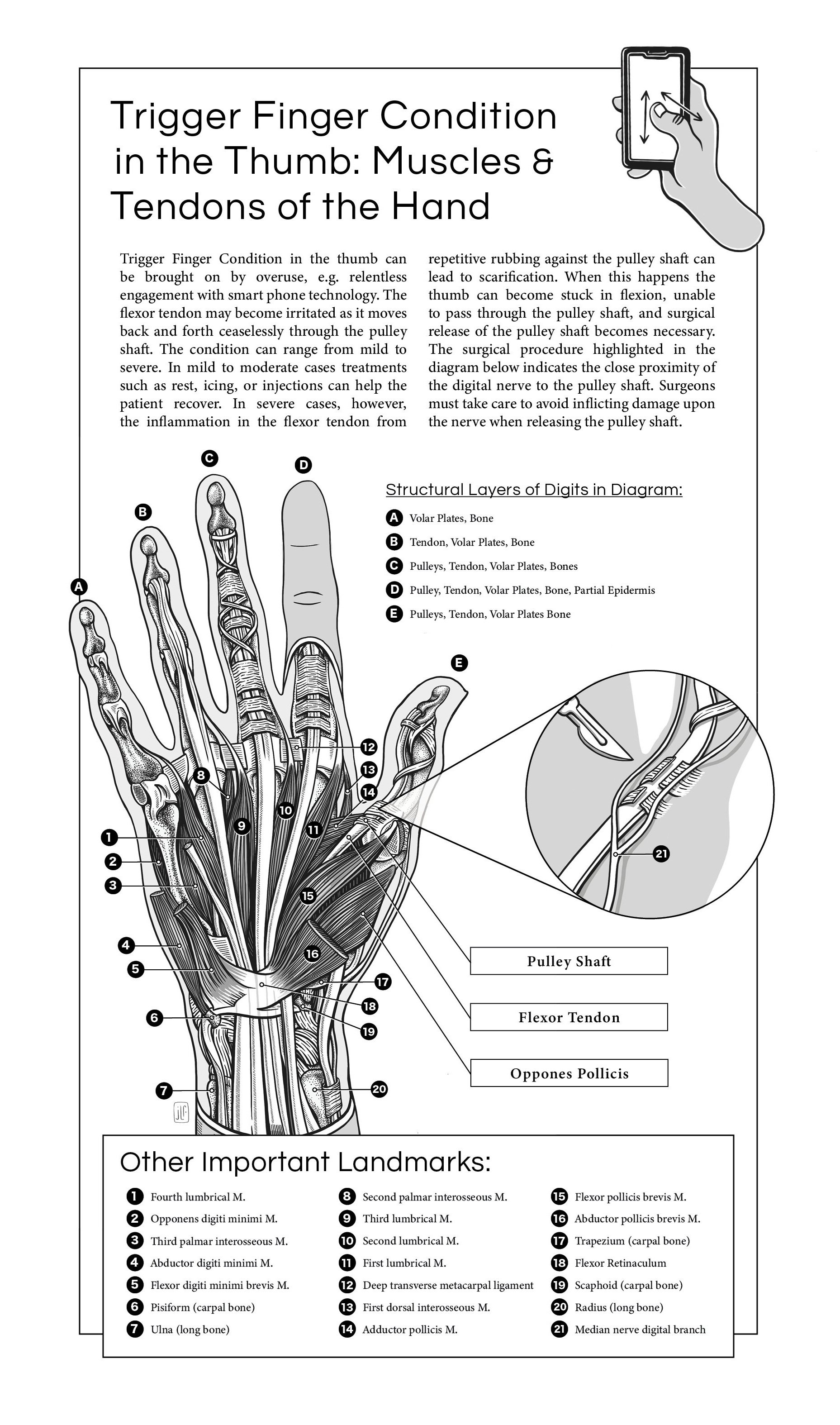 Trigger Finger Condition Illustration