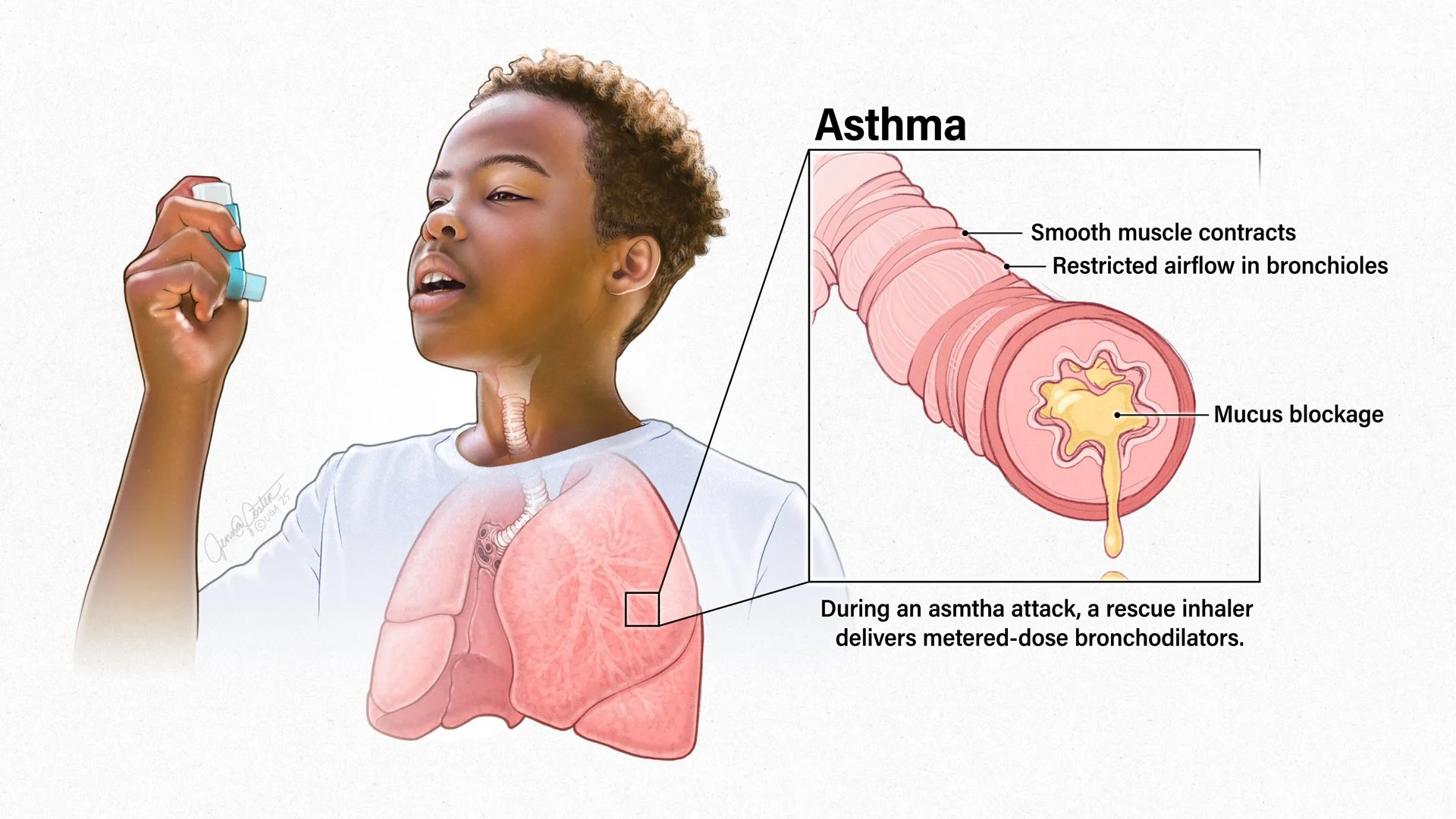 Asthma