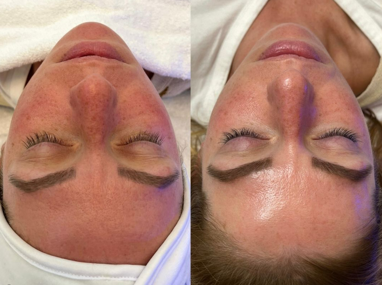Hydrafacial treatment in philly  (1).png