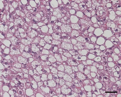 Hematoxylin-eosin staining reveals hepatic micro- and macrovesicular steatosis (Aleix Ribas-Latre and Baharan Fekry)