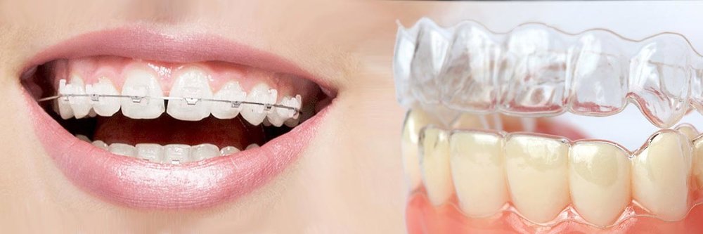 Invisalign Walnut Creek, CA - Invisalign Clear Braces