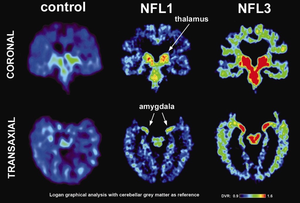 NFL Brains CTE.jpeg