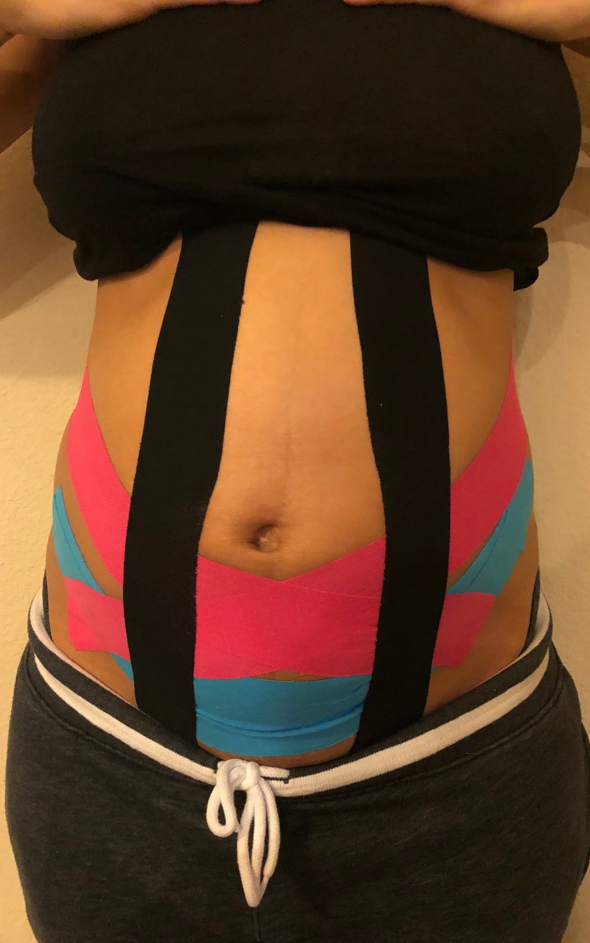 Kinesiotaping for Pregnancy! How KT tape can Help with Rib Pain 