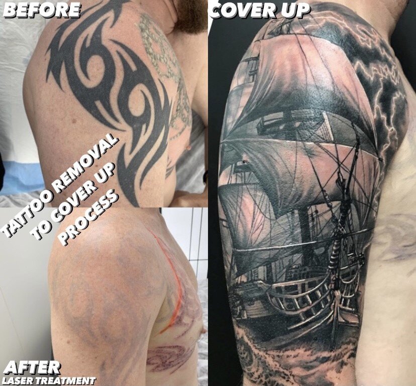 Tattoo Sleeve Removal Results  Removery