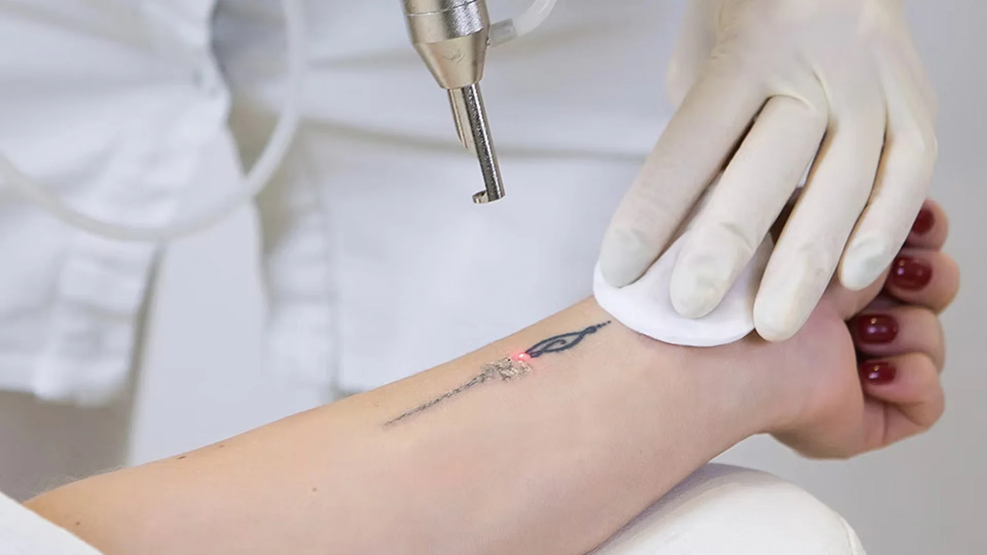Unveiling the Secrets of Laser Tattoo Removal: The Science Behind It All