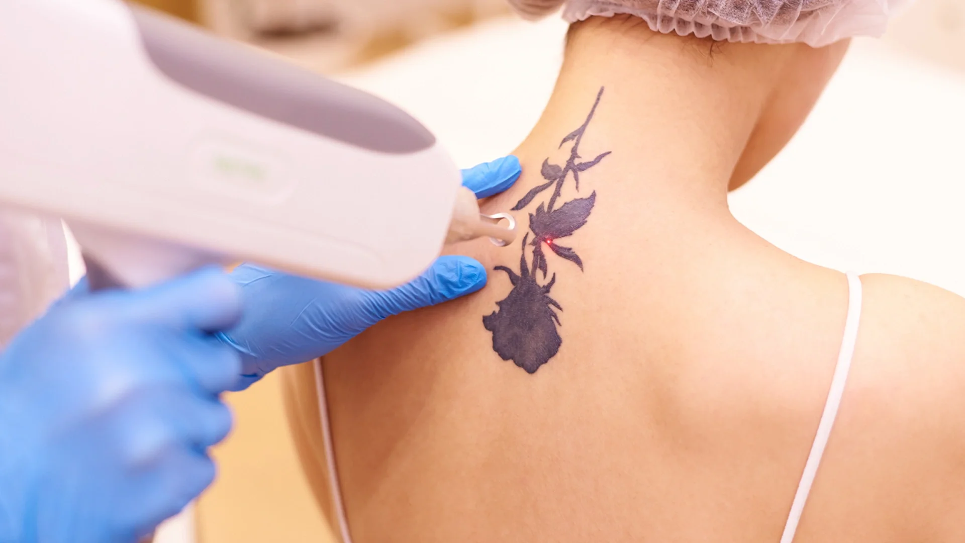 Breaking Down the Laser Tattoo Removal Process: From Pigment to Fading
