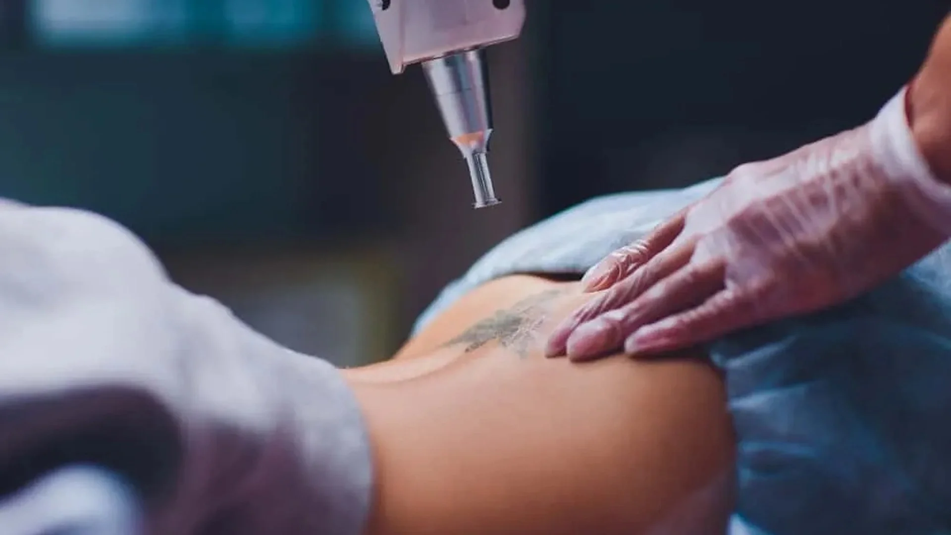 When to Choose Laser Removal Before a Tattoo Cover-Up