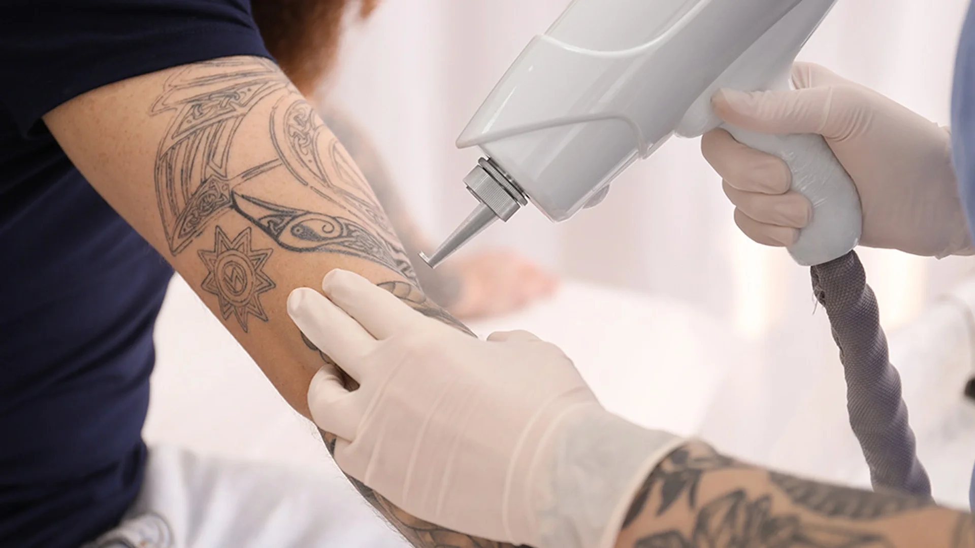 Is Laser Tattoo Removal Safe? What You Need to Know About the Process and Aftercare
