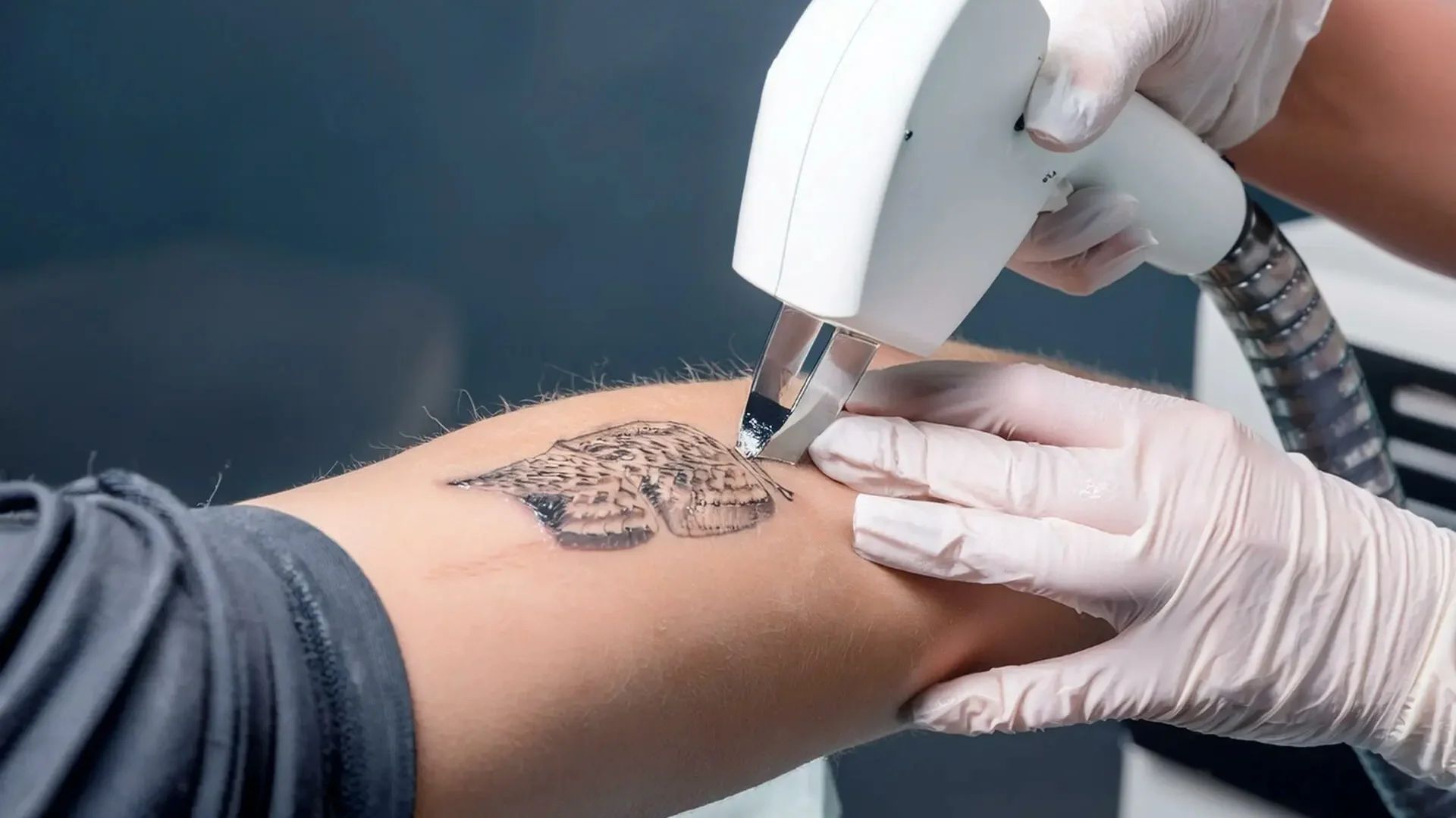 Laser Tattoo Removal for Sensitive Skin: What Ocean Ink Does to Keep Your Skin Safe