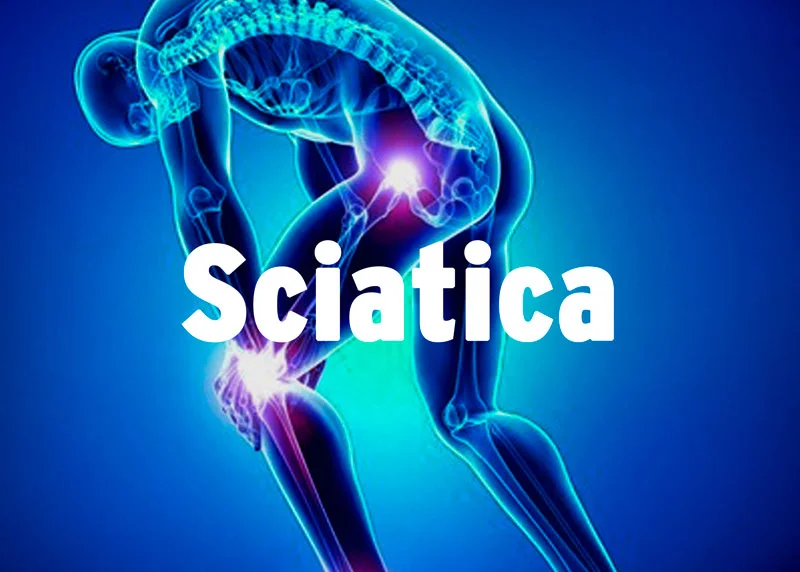 What is Sciatica?