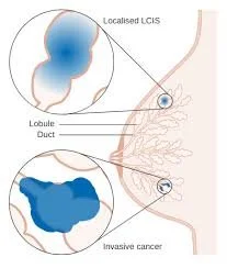 Lobular Breast Cancer