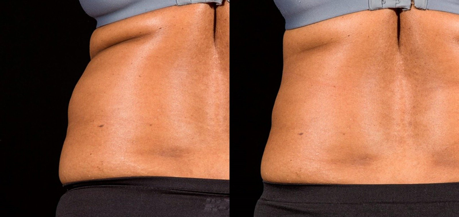 Sculpsure1.jpeg