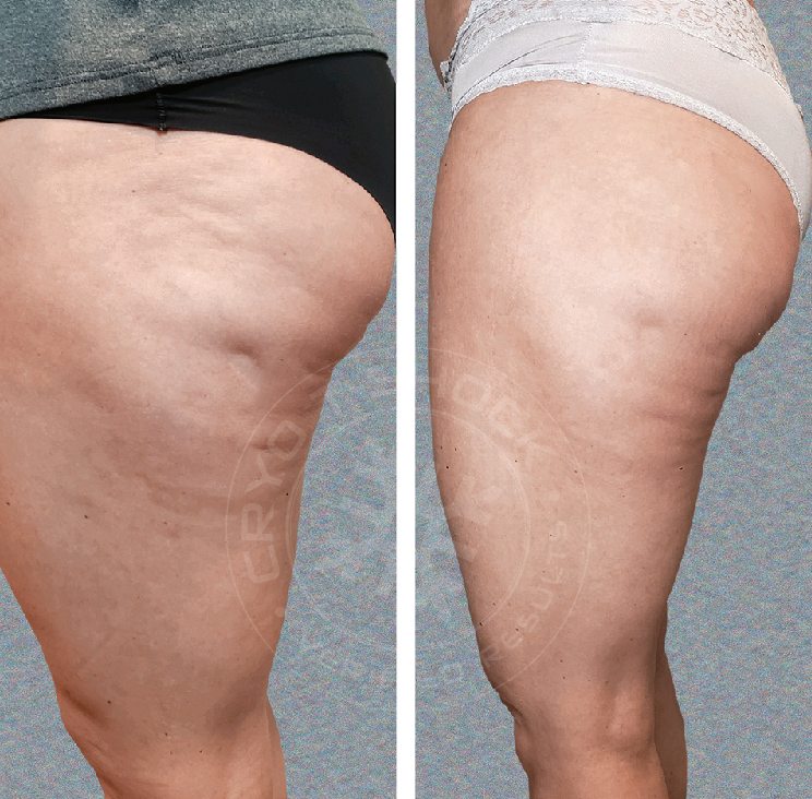 3 cellulite.png