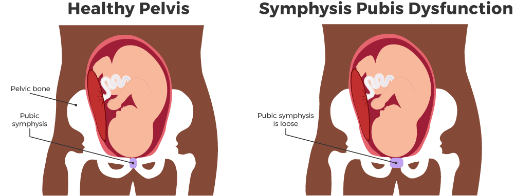 symphysis-pubis-dysfunction.gif