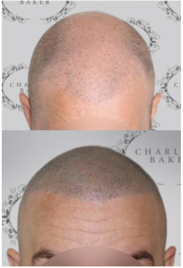 Scalp Micro Pigmentation