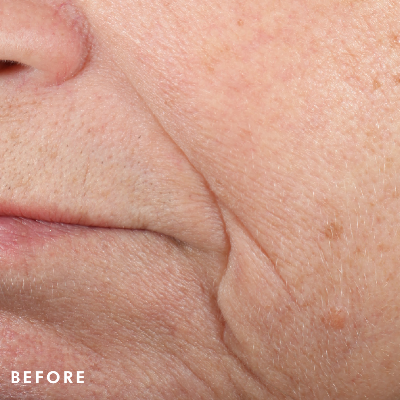 Triple-Lipid-Restore-Before-Image-SkinCeuticals.png