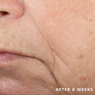 Triple-Lipid-Restore-After-Image-SkinCeuticals.png