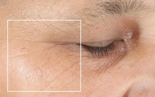 Crows Feet before.jpg