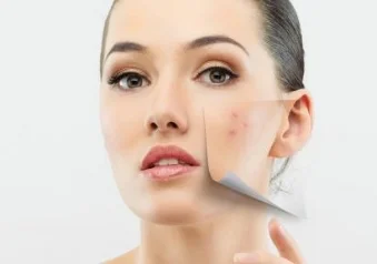 199713-411x288-Acne-on-face.jpg