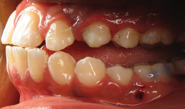 How To Stop Tongue Thrusting Teeth : 36 Tongue Thrust Correction Ideas