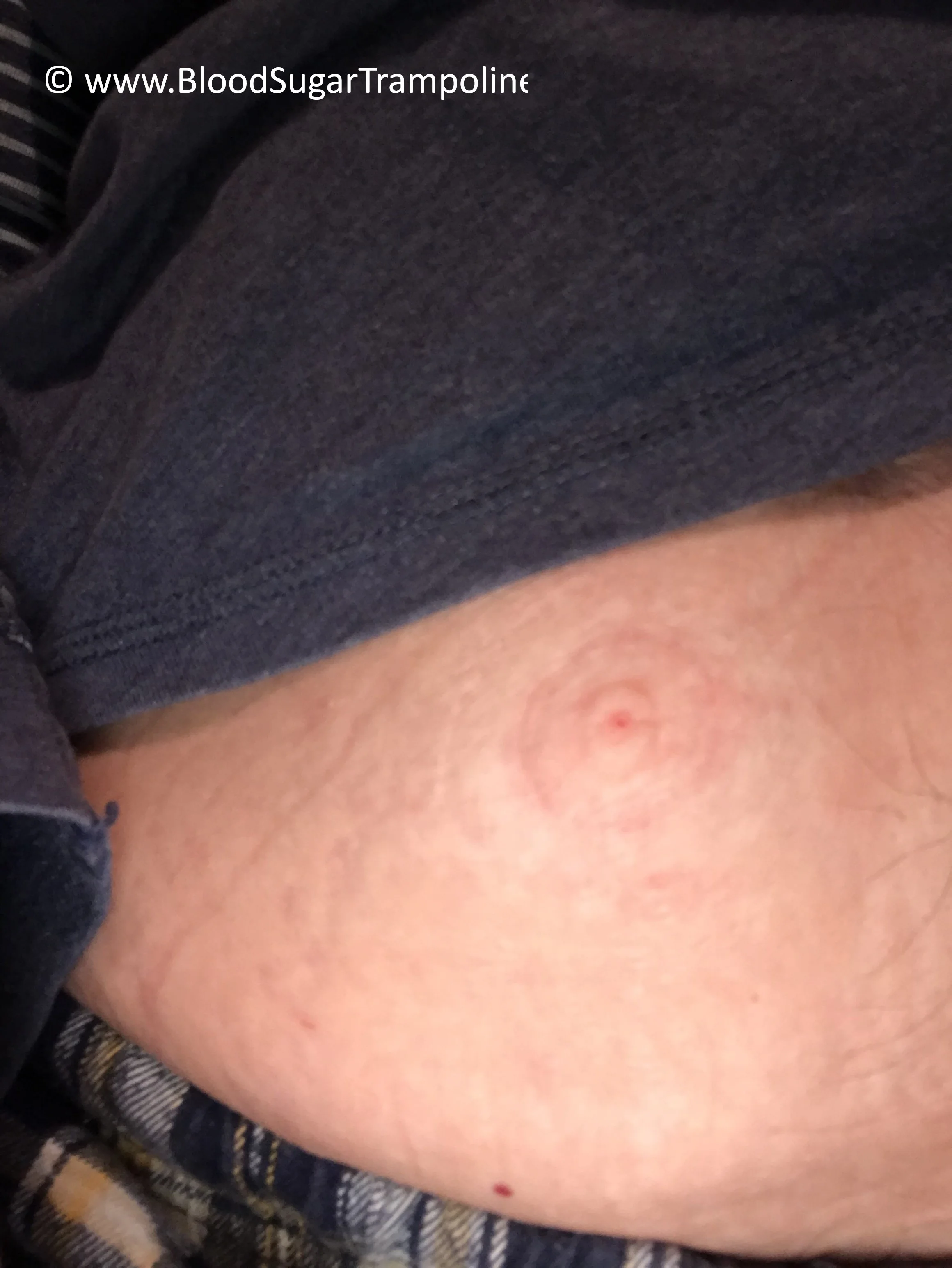 This is the puncture mark left on my stomach after every insulin pump needle change.