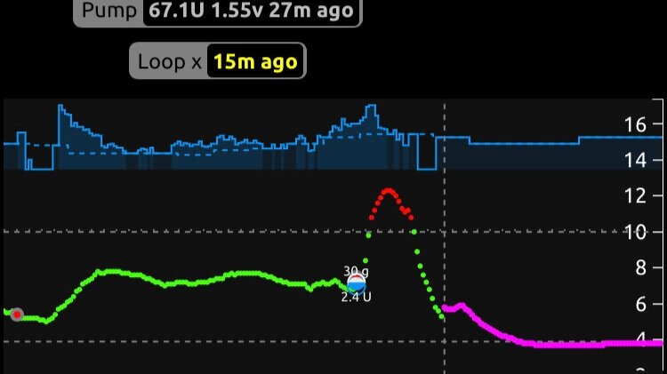 My DIY Artificial Pancreas Journey
