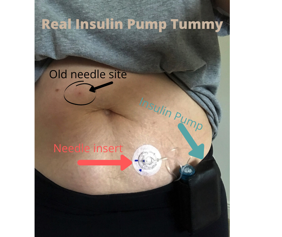 Diabetes Insulin Pump Needle Clogs Blood Sugar Trampoline