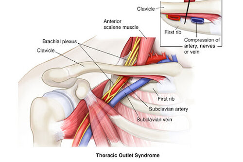 💥Thoracic Outlet Syndrome💥 - 🎯 Thoracic Outlet Syndrome, or TOS,  describes a condition in which the nerves and/or blood vessels