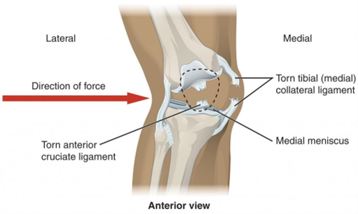 MCL Damage  Bowen Hefley Orthopedics