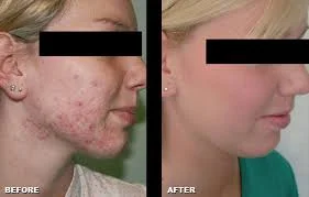 photodynamic therapy.jpeg