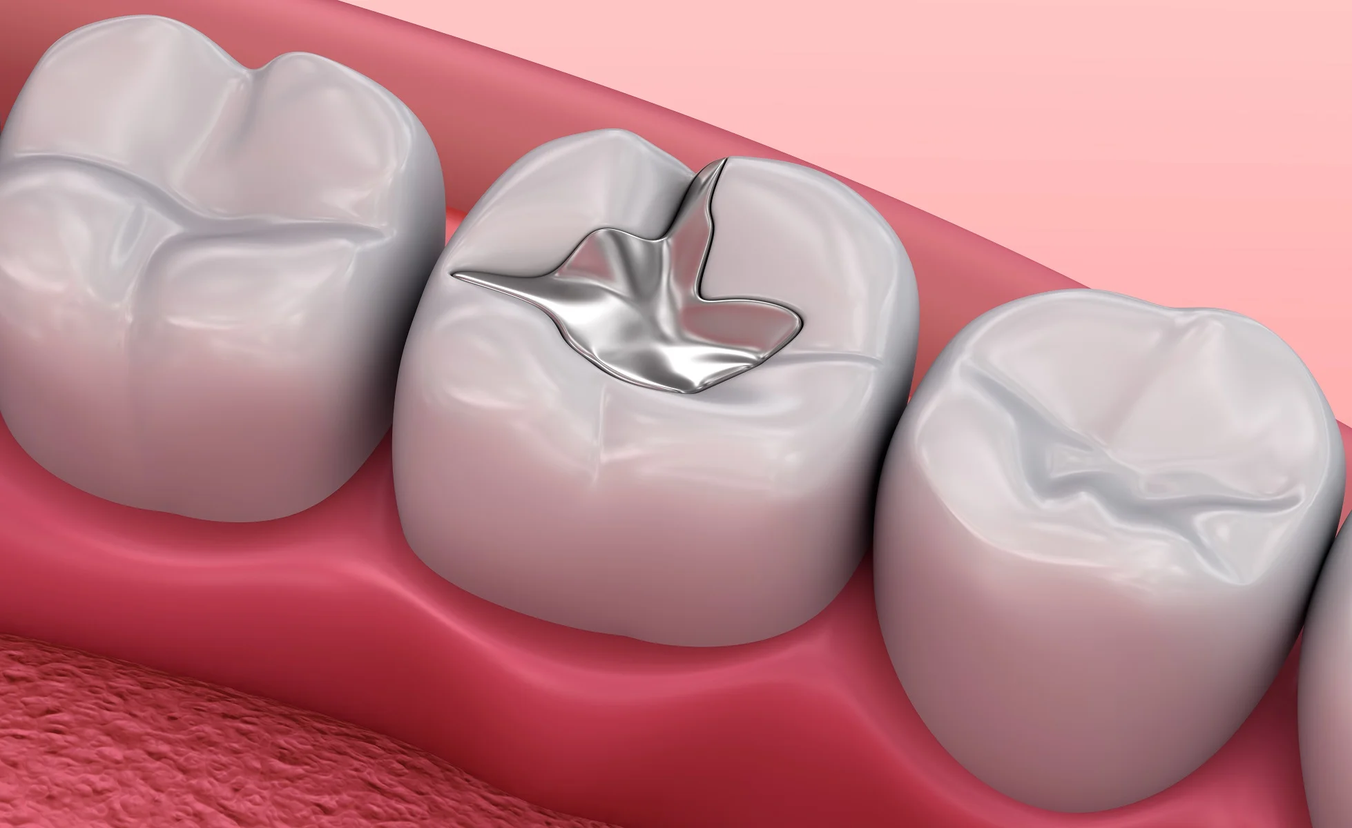 restorative-fillings.jpg