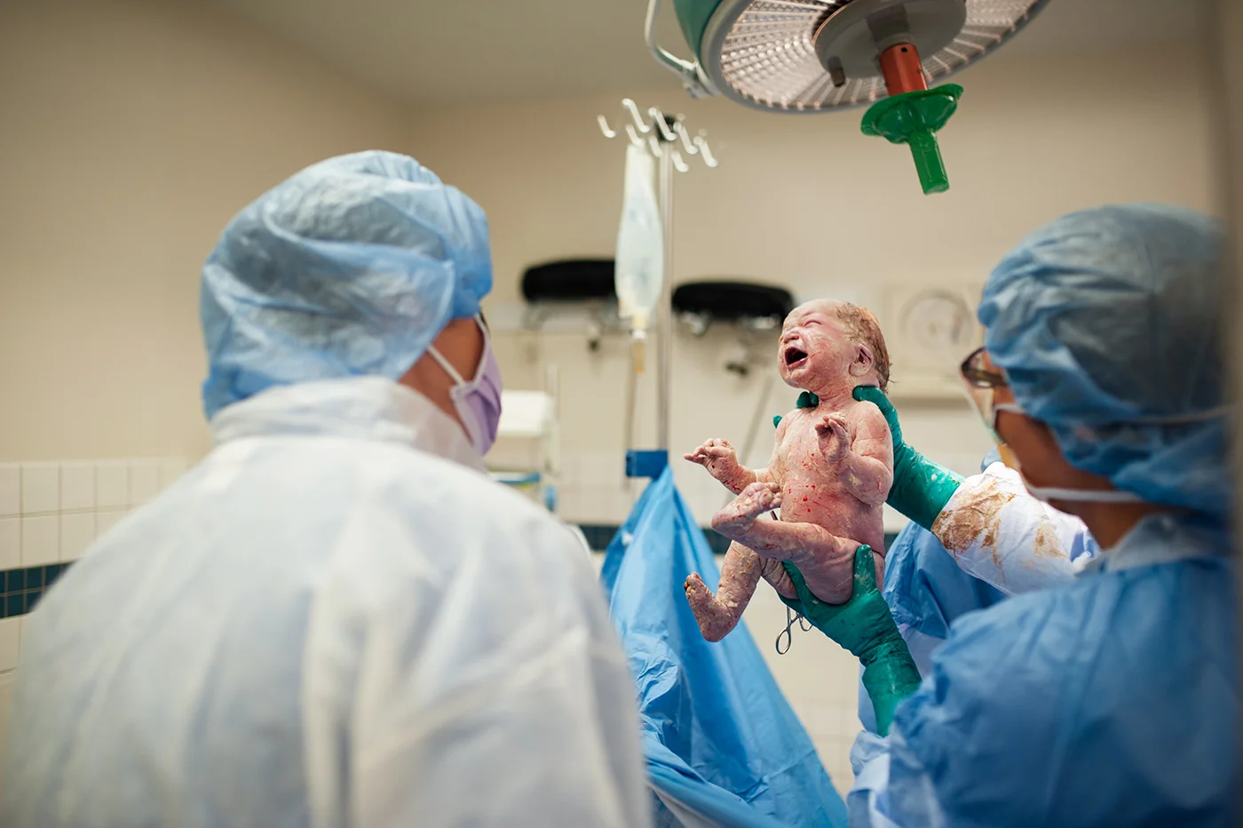 A newborn baby being born via cesarean birth at Piedmont Hospital Atlanta