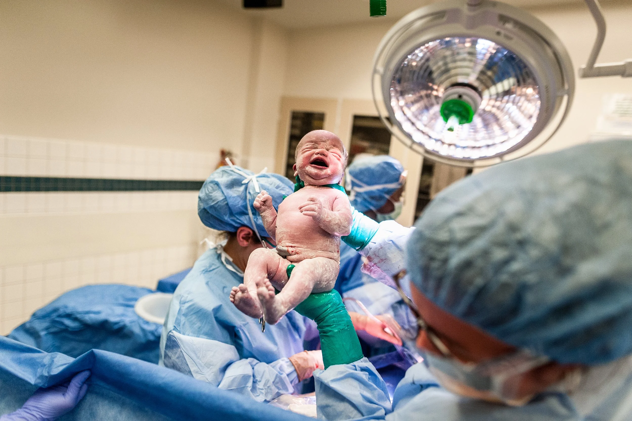 Newborn baby being born via cesarean at Piedmont Atlanta