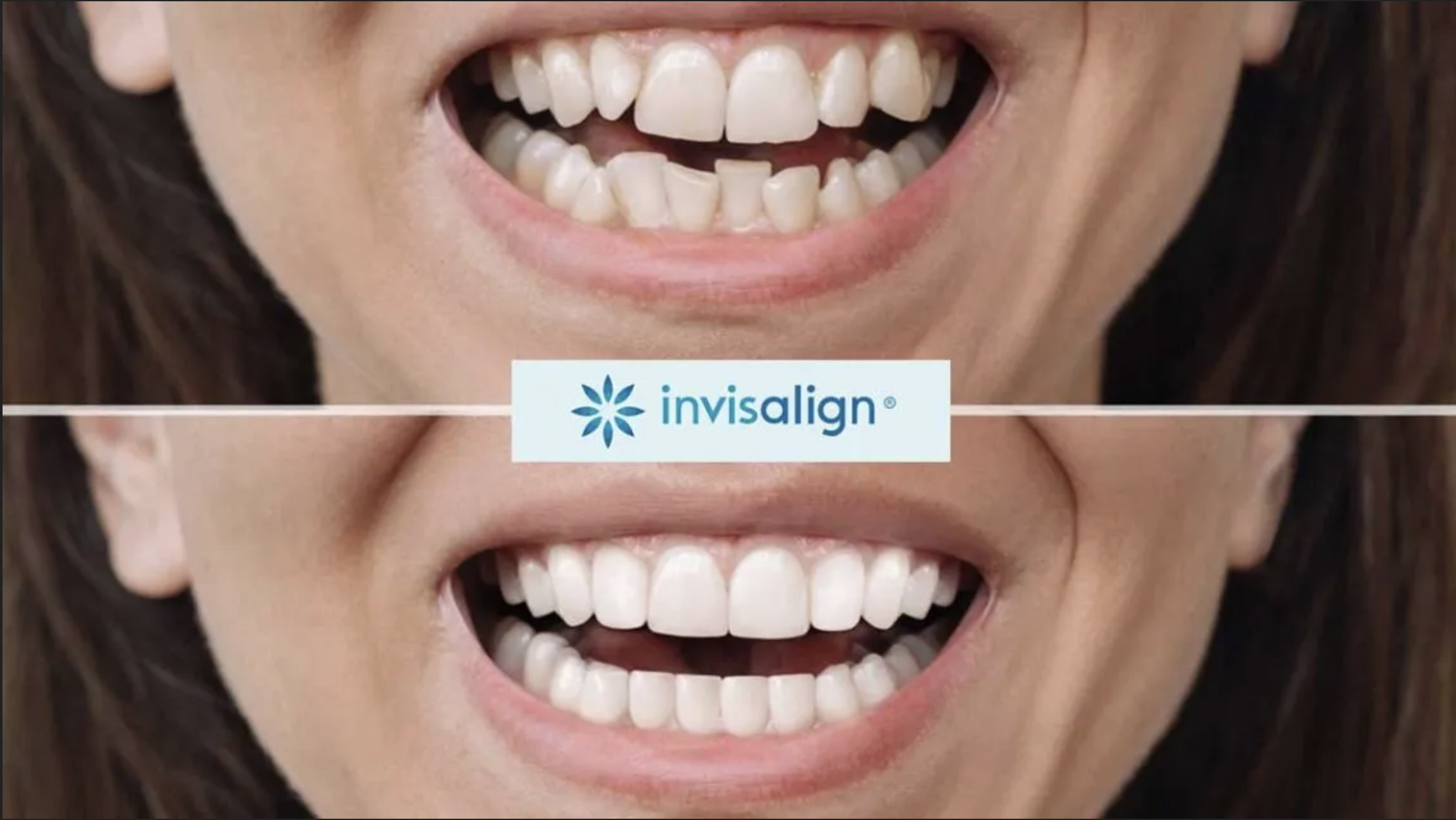Invisalign behandling före, efter