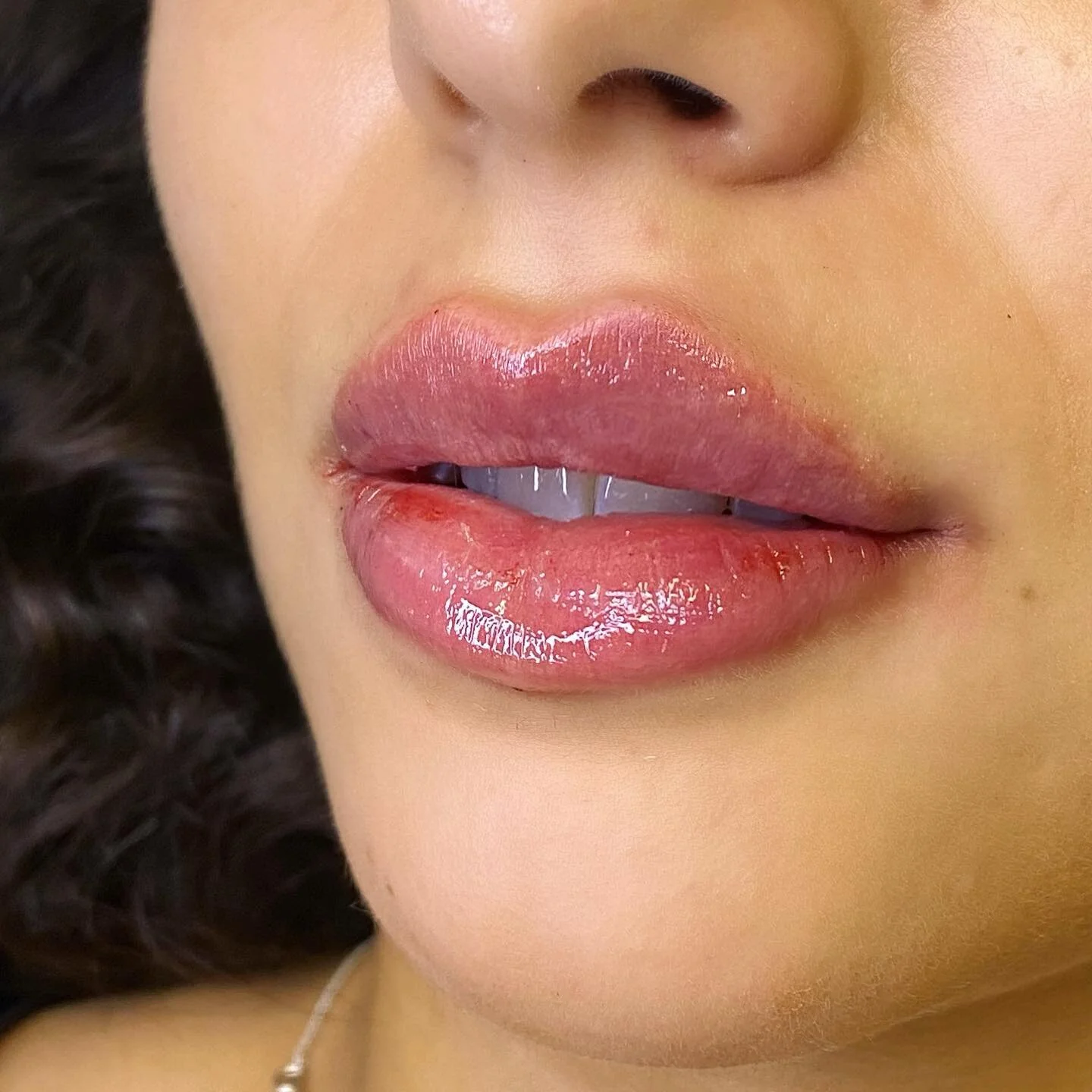 S&aring; fint med lite extra fokus p&aring; form. 
V&auml;lkommen att boka: 
#filler 
#botox
#skinbooster 
#prp 
#prf 
#tandblekning 
#skulptra 
#tr&aring;dlyft 

Jag har valt att bara fokusera p&aring; behandlingar som ger resultat. &Auml;r det n&ar