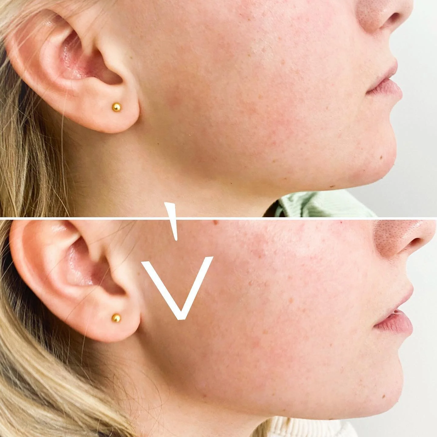 K&auml;klinjen kan ge s&aring; fin balans i ansiktets konturer. Det &auml;r en behandling som oftast kr&auml;ver lite mer volym. 

Paketpriser 
3 ml : 6900:- 
4 ml : 8000:- 
D&auml;refter 2000:- per spruta. 
Man kan blanda m&auml;rke, omr&aring;de oc