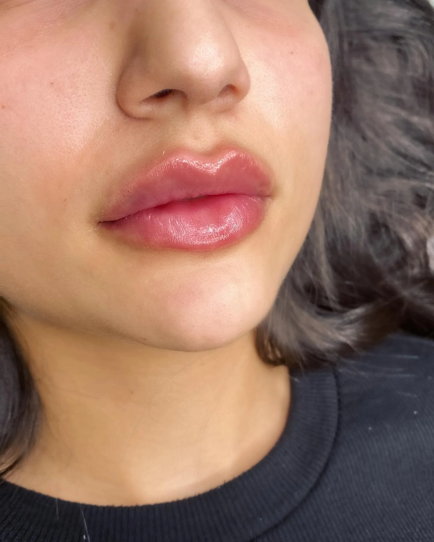 L&auml;ppar direkt efter behandling. T&auml;nk p&aring; att l&auml;pparna blir svullna, r&ouml;da och k&auml;nsliga direkt efter behandlingen s&aring; det &auml;r bra att ta det lite lugnt resten av dagen 💫

#lips #l&auml;ppar #l&auml;pparmalm&ouml;