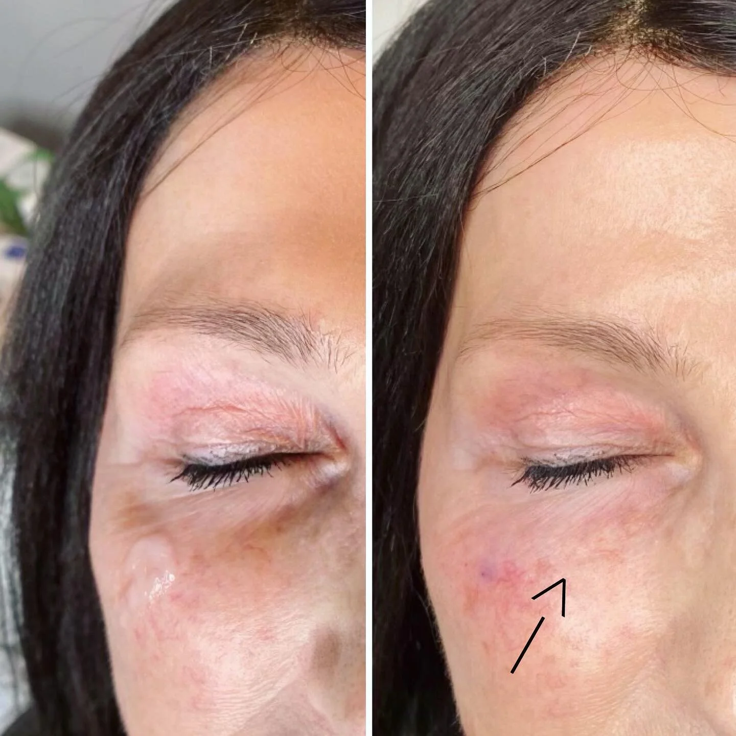 Tear trough!
En av mina favoritbehandlingar. H&auml;r finns flera behandlingsalternativ 
- Hudbehandling med olika syror och serum individuellt anpassade 
- Microneedling / Dermapen 
- Biostimulerare 
- Kollagenstimulerare 
- Blodplasma, PRF 
- Tr&ar