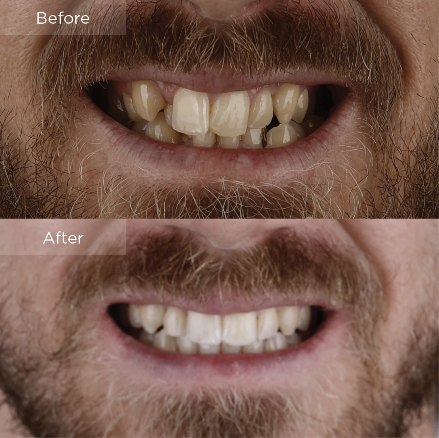 Invisalign behandling, en man med skägg visar tänder