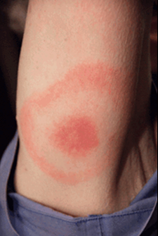 Lyme Disease Prevention