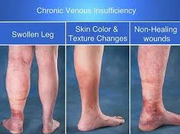 Chronic Venous Disease  (CVD) and Hemorrhoids